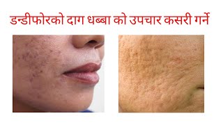 dandifor ko daag hataune upay ? dandifor , pimples in nepali l acne scar removal,treatment in nepali