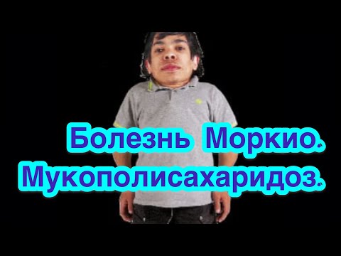 Синдром Моркио. Мукополисахаридоз.