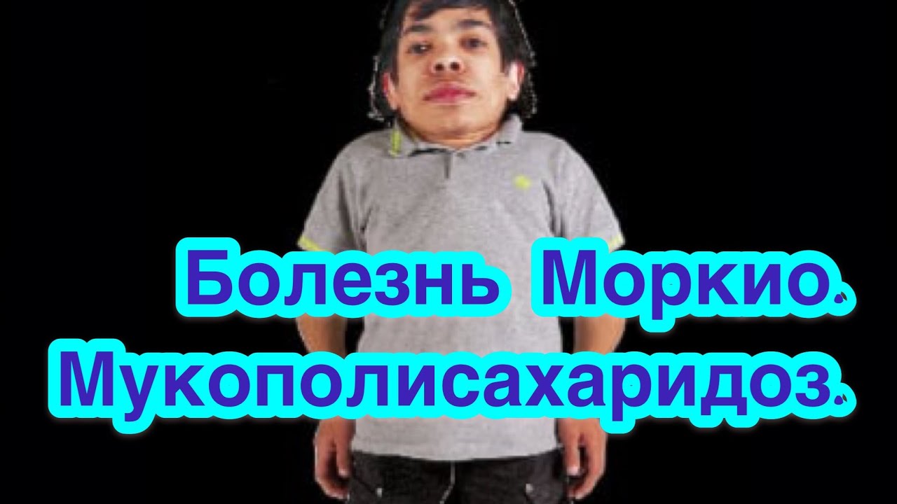 Синдром Моркио. Мукополисахаридоз.