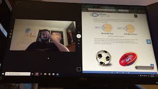 Talon Voice Eye Tracking Issues Resolved - Keratoconus Skewing Accuracy