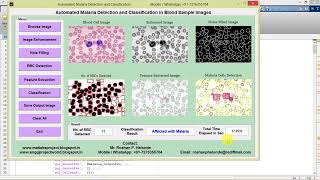 Malaria Parasite Detection and Classification in Blood Sample Images Using Matlab Project Code