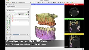 DentalSegmentator 3D Slicer extension