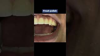 How we remove orthodontic glue from teeth after treatment Details