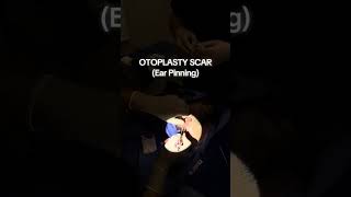 Ear pinning Scar #scar