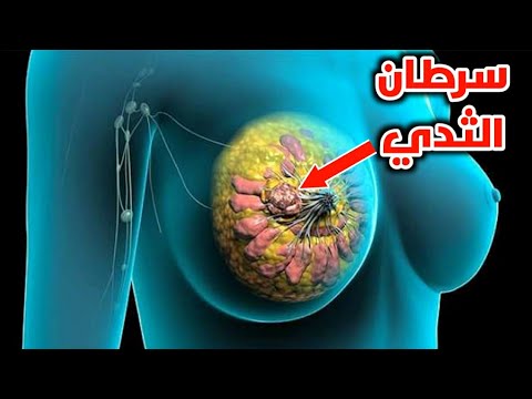 فيديو: كيفية التعرف على كتلة في الثدي: 9 خطوات (بالصور)