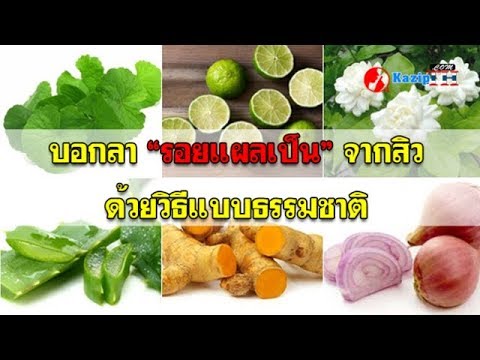 8 วิธีลบรอยแผลเป็นนูน ด้วยสูตรธรรมชาติ [เคล็ดลับสุขภาพ]