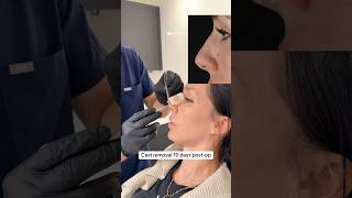 Cast removal 10 days after rhinoplasty | Dr. med. Simon Zimmermann