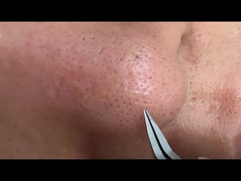 Small Blackheads on nose removal 5 minute - YouTube