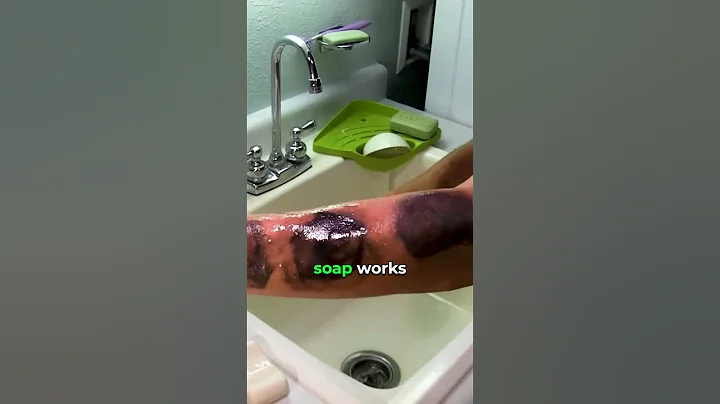 How to never get a serious Poison Ivy Rash again 🌿