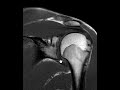 How to read an MRI of the shoulder