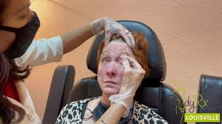 How many units of BOTOX for face | Botox treatment at BodyRx, Louisville KY