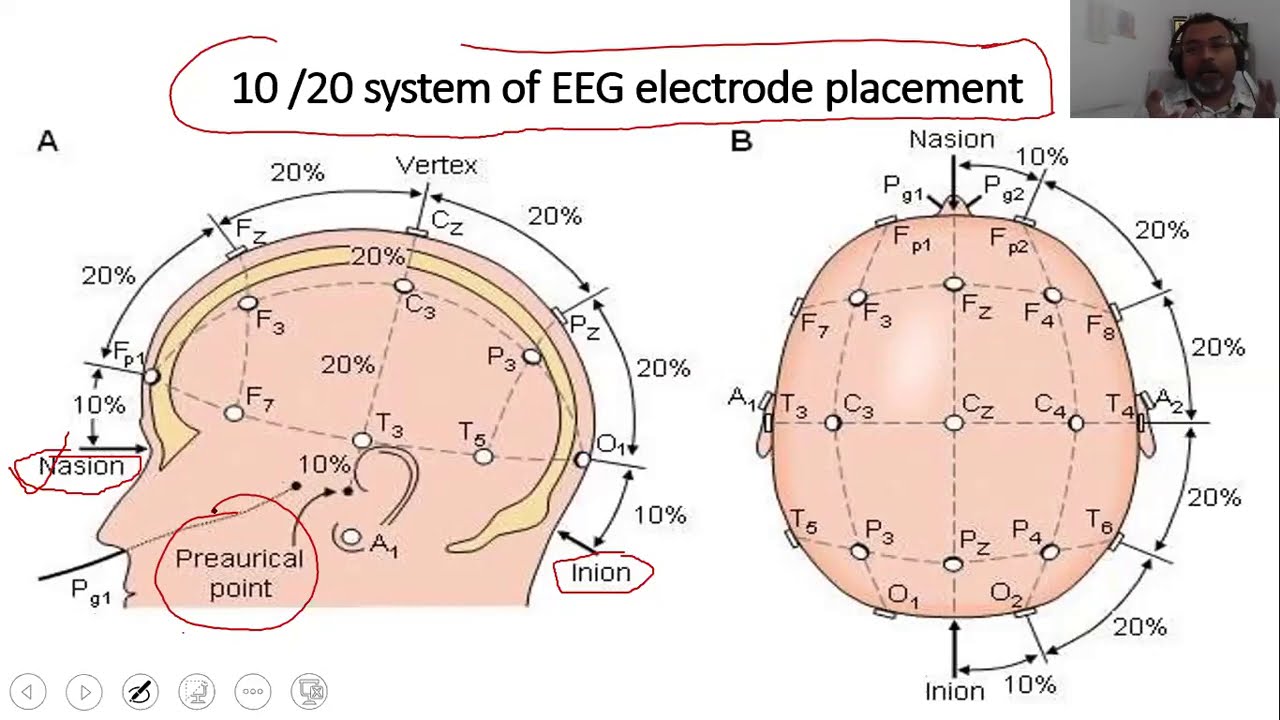 Eeg Lead Placement Diagram