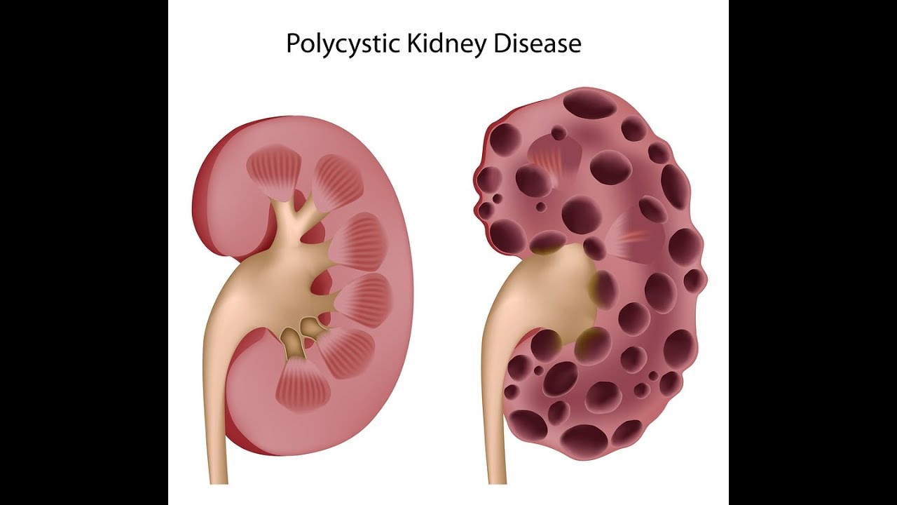 does sulfasalazine cause kidney failure