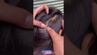 (Part 11) Lice Removal & Treatment: Advanced Lice - Picking Secrets