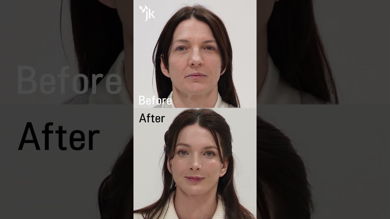 The Art of the Profile: Masterful 180° Facelift Results 🎨
