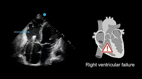 Recognizing poor right ventricular systolic function in echocardiography