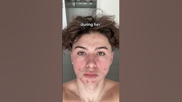 Before and after❤️‍🩹