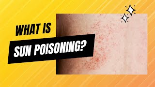 What is sun poisoning? What Do You Do About Sun Poisoning