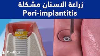 زراعة الاسنان مشكلة –   Periimplantitis ©