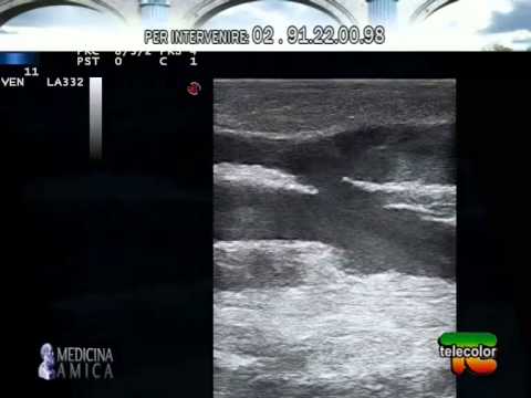 Video: Pressione Arteriosa Pulsante Che Imita L'apertura Della Valvola Aortica Durante Il Supporto LVAD A Flusso Continuo: Un Caso Clinico