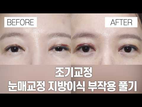 눈 성형 전후 |  조기교정 - 눈매교정 지방이식 부작용 풀기 일주일 전후