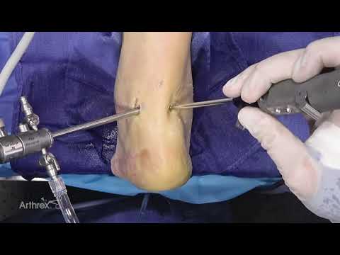 Arthroscopic Posterior Ankle Debridement Using the Retractable Hood Burr