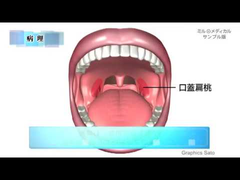 急性扁桃炎／ミルメディカル　家庭の医学 動画版