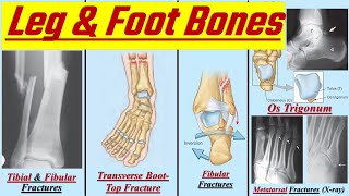 Clinical Correlations of Bones (3/3) || Lower Limb || كلية الطب - مادة التشريح || (M1---) || [15] screenshot 2