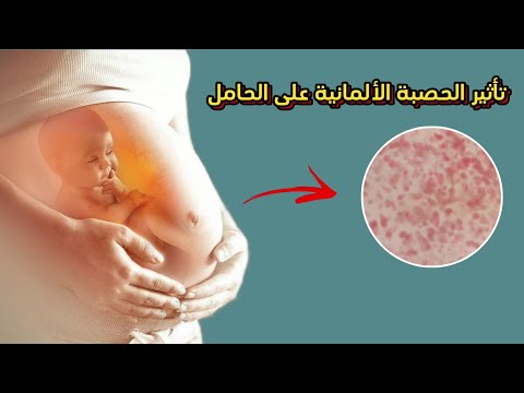 الحصبة الألمانية وتأثيرها على الحامل