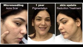 This video is about my 1 year update on micro needling skin update.
acne scar reduction, pigmentation, old age wrinkles treatment. hope
you enjoy and ...