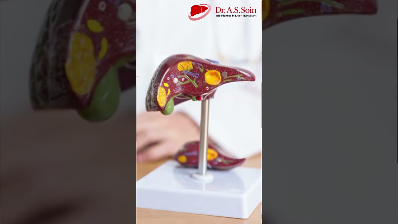 Liver Cirrhosis में Transplant कब होता है ज़रूरी? 🤔 जानें Stage A, B, C का सच! 🩺 | Dr. A.S Soin