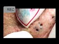 Big blackheads removal very satisfying  removal hidden blackheads and acne blackheads popping