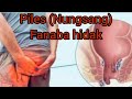 Piles, Nungsang fanaba hidak 