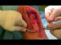 Patellar tendon repair