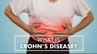 What Is Crohns Disease? Dr. Jeffrey Linder Top10Md