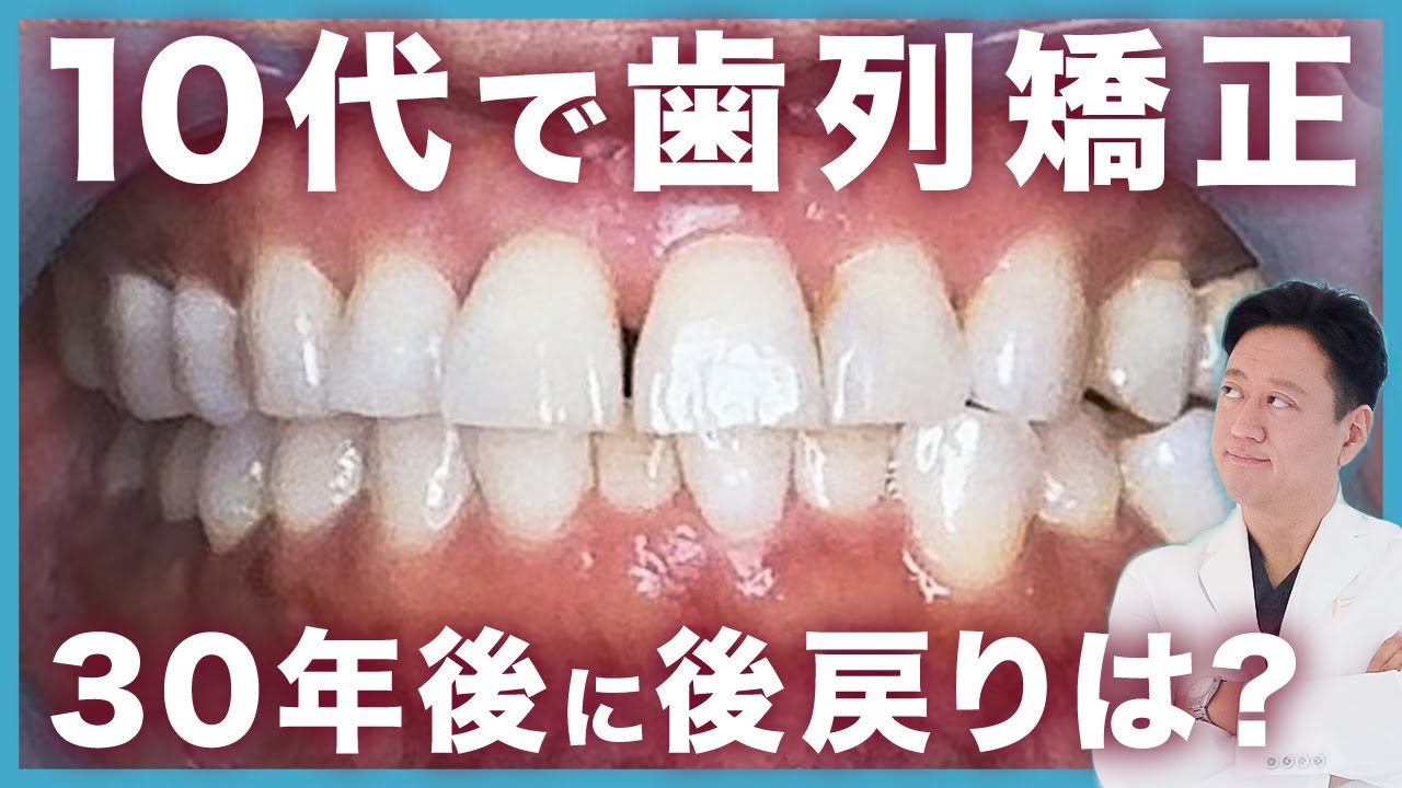 後戻りは何年後に起きる?矯正後の後戻りの原因と対処法を解説します!【審美歯科 歯列矯正 歯並び】 - YouTube