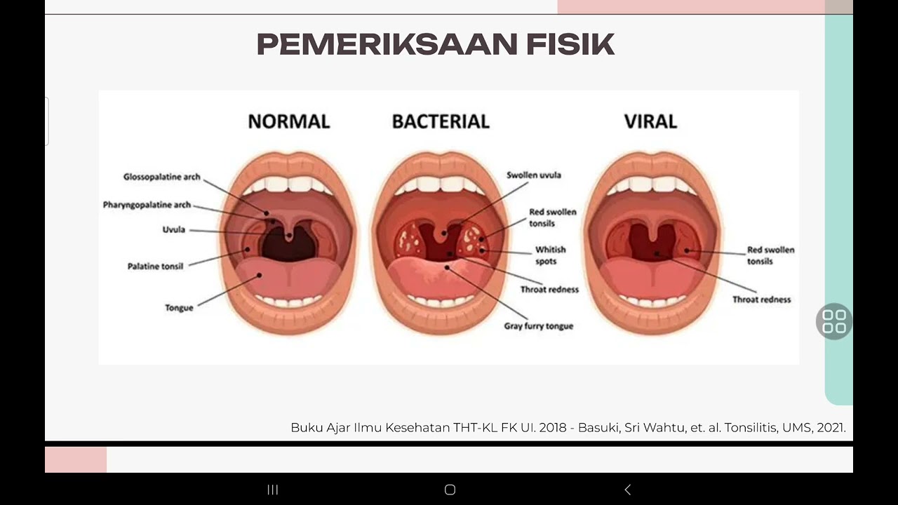 TONSILITIS | REFERAT THT