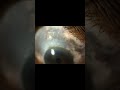 #Blue#Sclera#Osteogenesis#Imperfecta#Brittle#Disease#Marfans#Syndrome#Connective#Tissue#Disorder#