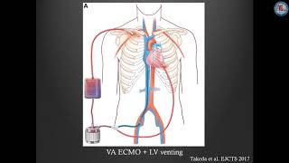 Awake and fully mobile patients on cardiac extracorporeal life support