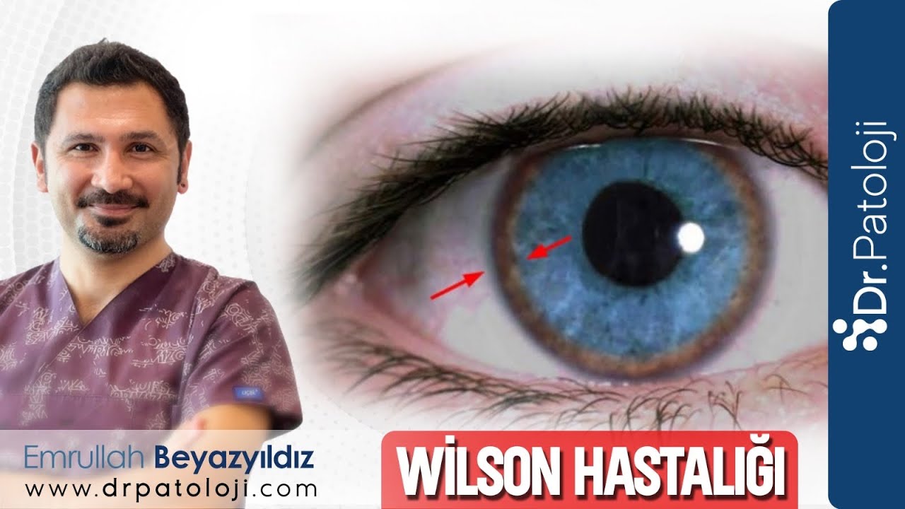 Wilson Hastalığı