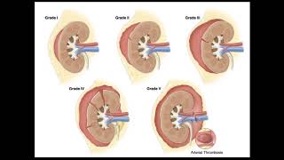 Blunt Abdominal Trauma Part 4   Renal Injury