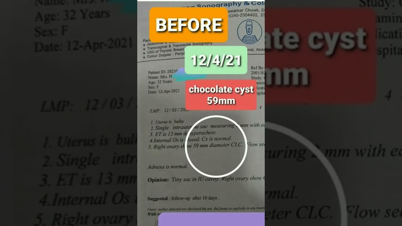 Challenging case of "Chocolate Cyst" cured with Homeopathy