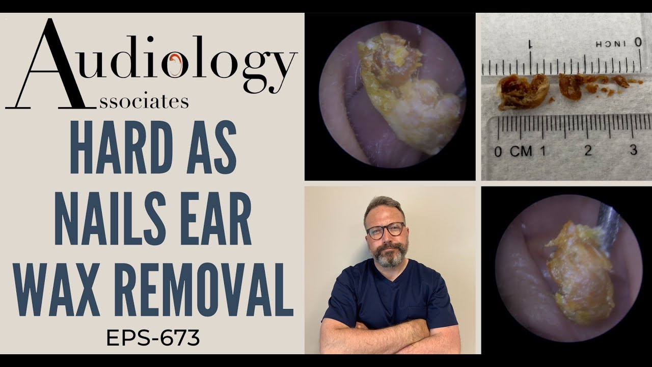 HARD AS NAILS EAR WAX REMOVAL EP673 YouTube