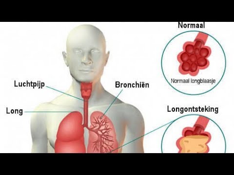 Longontsteking: symptomen en remedies