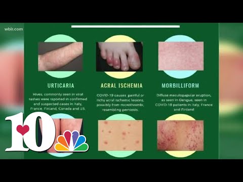 Video: Způsobuje covid kožní léze?