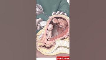 Amniocentesis Explained: The Procedure, Risks & Benefits