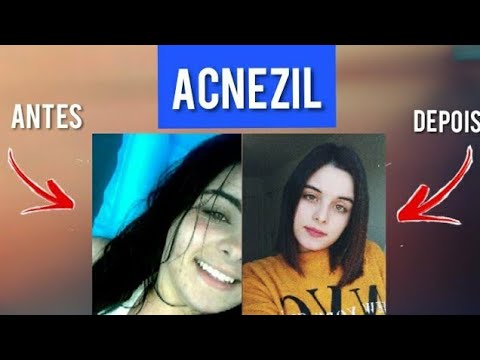 ACNEZIL GEL | antes x depois - YouTube