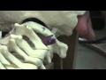 APSS Workshop Video 7 Posterior C1/C2 Fixation and Lateral Mass Fixation