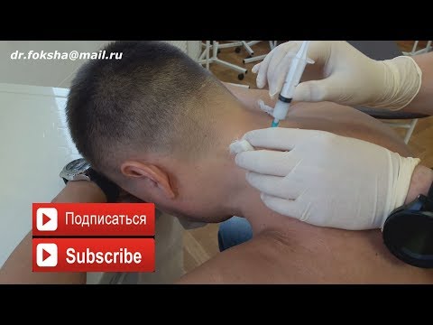 Лечение БОЛЬ В ШЕЕ | БЛОКАДА | Cervical Injections