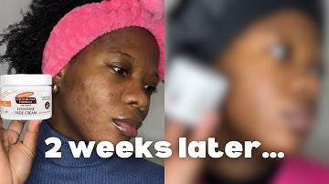 I Tried Palmer’s Cocoa Butter Fade Cream for 2 Weeks – Did It Fade My Acne Scars? | Part 2
